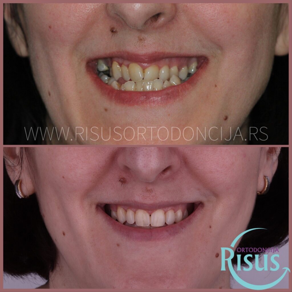 PRE I POSLE TERAPIJE14