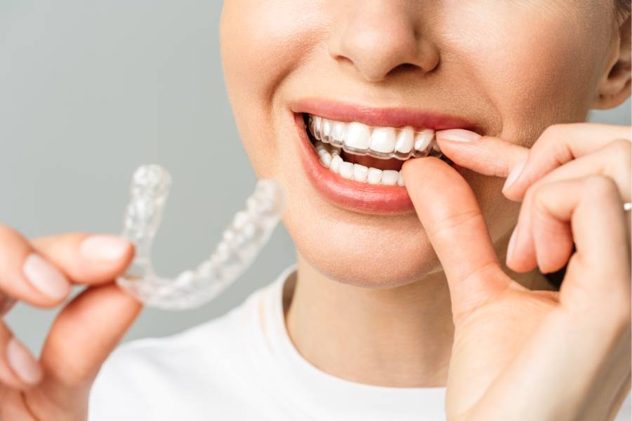 Širok kadar osmeha devojke koja stavlja Invisalign folije na gornju vilicu.